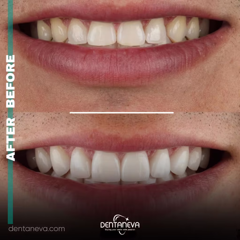 Complete Breakdown of All on 4 Dental Implants Price: Save Without Compromise 3 Why Choose Dentaneva Dental Clinic for Dental Implants Turkey