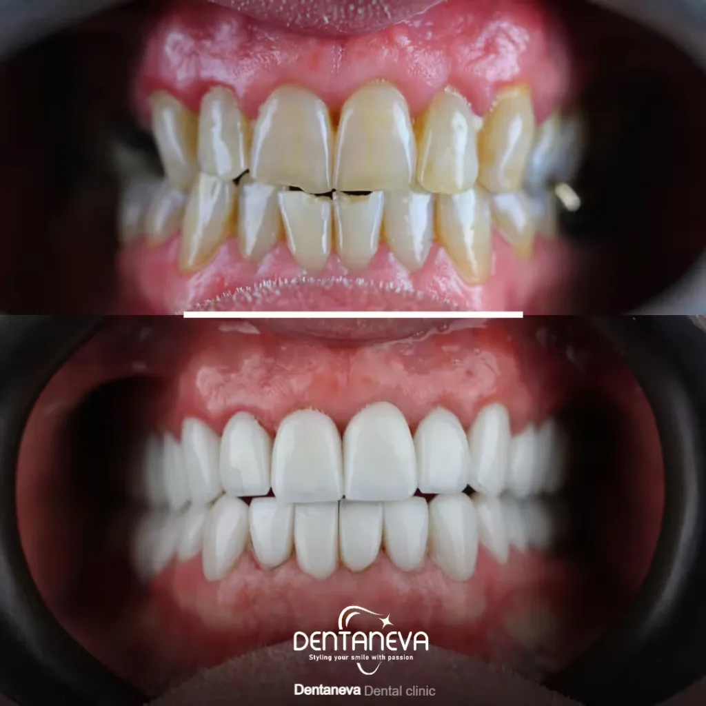 Top 9 Cheapest Dental Implants UK Options: Costs, Choices & How to Save 3 Why Choose Dentaneva Dental Clinic for Your Dental Implants