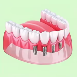 all on 4 dental implants