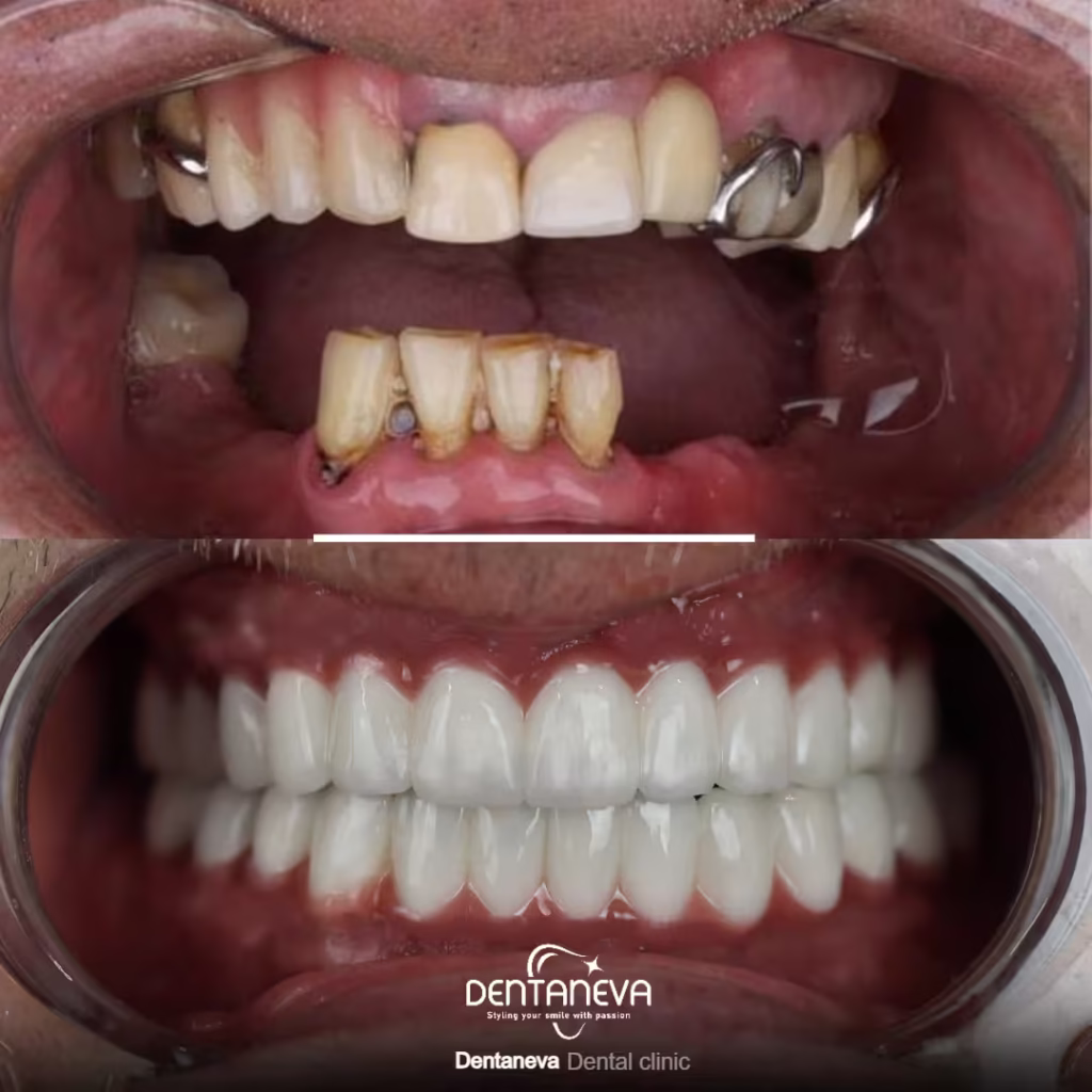 Front Dental Implants: 5 Key Facts for a Confident Smile 3 cheap dental implants uk before After