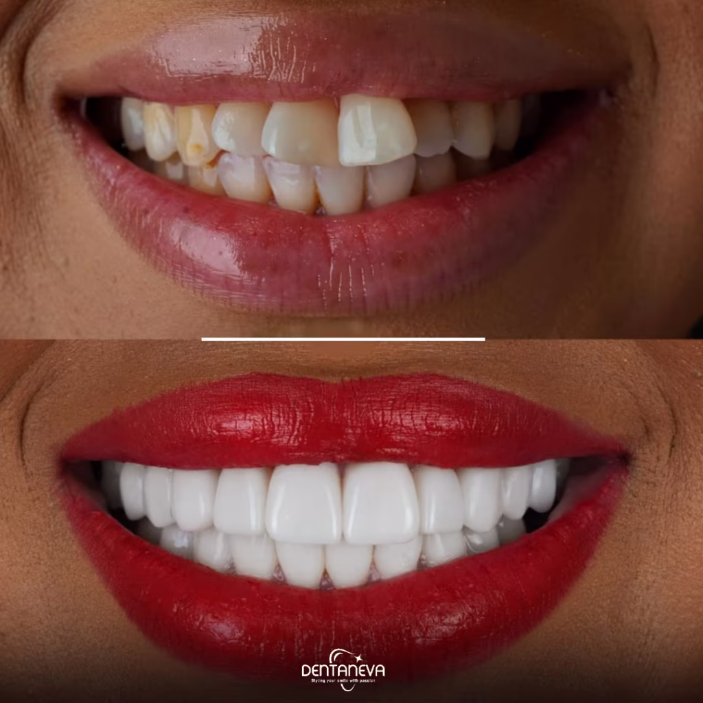 The Complete Breakdown of the Cost of Dental Implants: 7 Factors to Consider 2 screwless dental implants Before and after