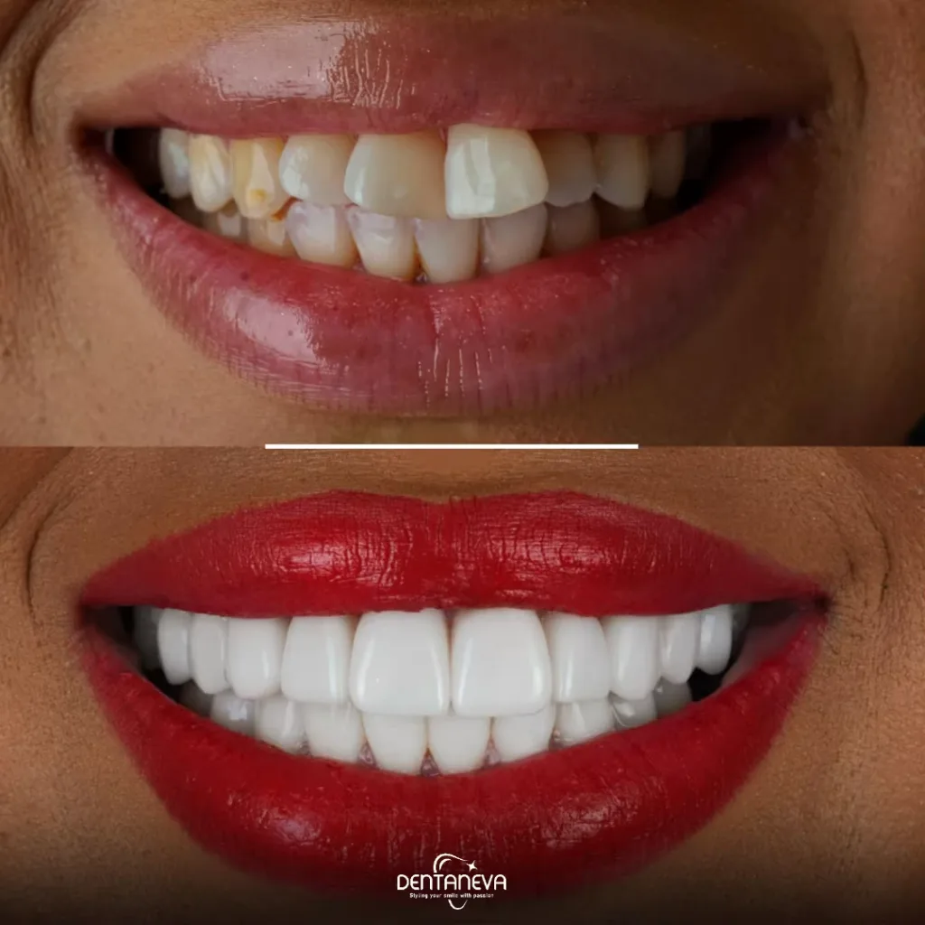 Screwless Dental Implants: 7 Key Facts on Benefits, Cost, and How They Compare 2 screwless dental implants Before and after