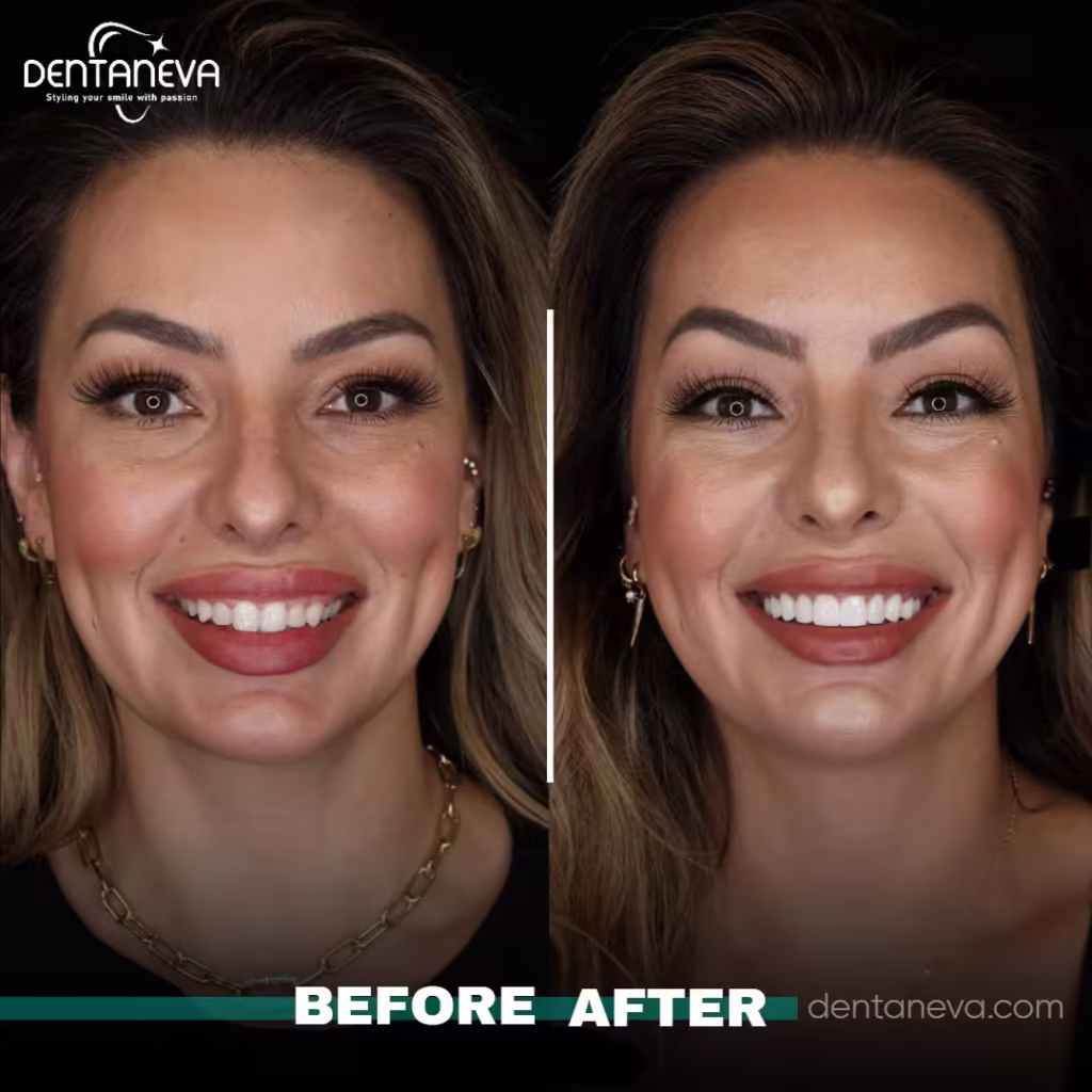 How Much Do Dental Implants Cost in 2025? Honest Price & Smart Choices 3 dental implants uk Before After