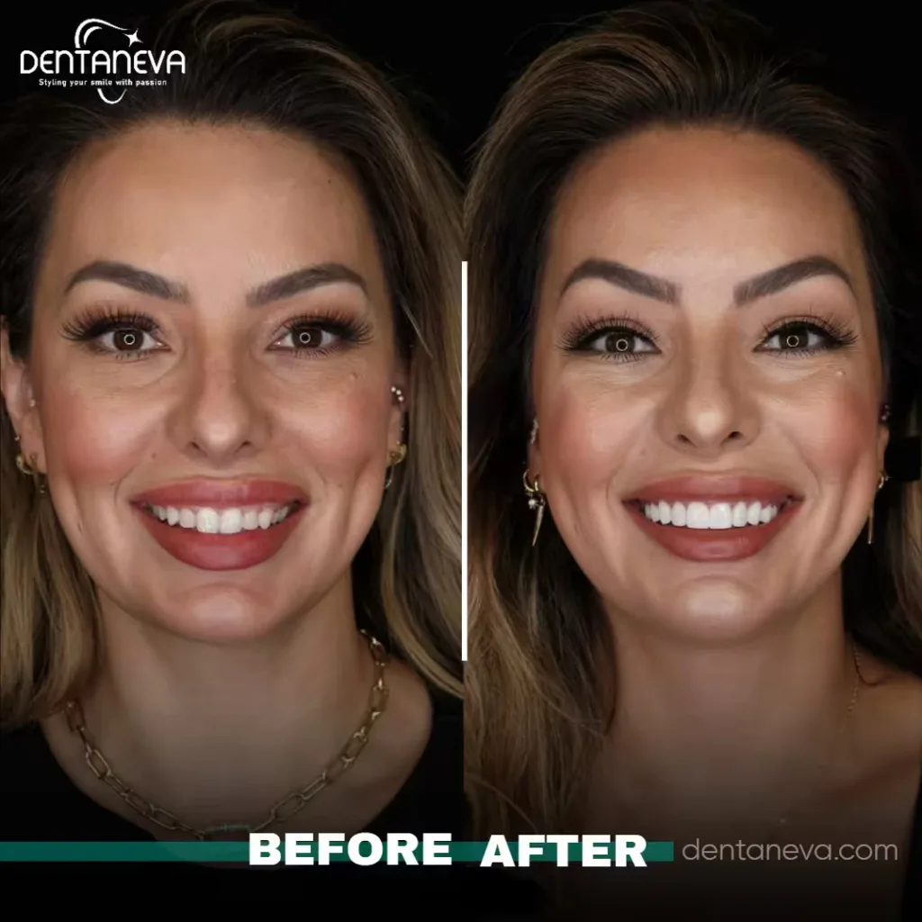 8 Signs That You Need Dental Implants — A Smart Solution for a Better Smile 2 dental implants uk Before After