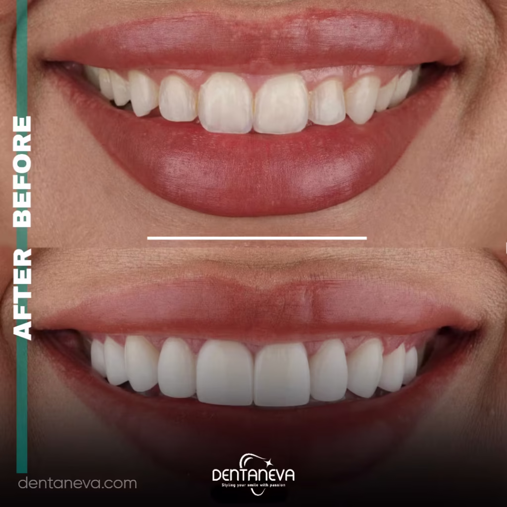 Full Mouth Dental Implants Cost: 7 Things You Need to Know Before You Pay 2 how much dental implants cost After Befor