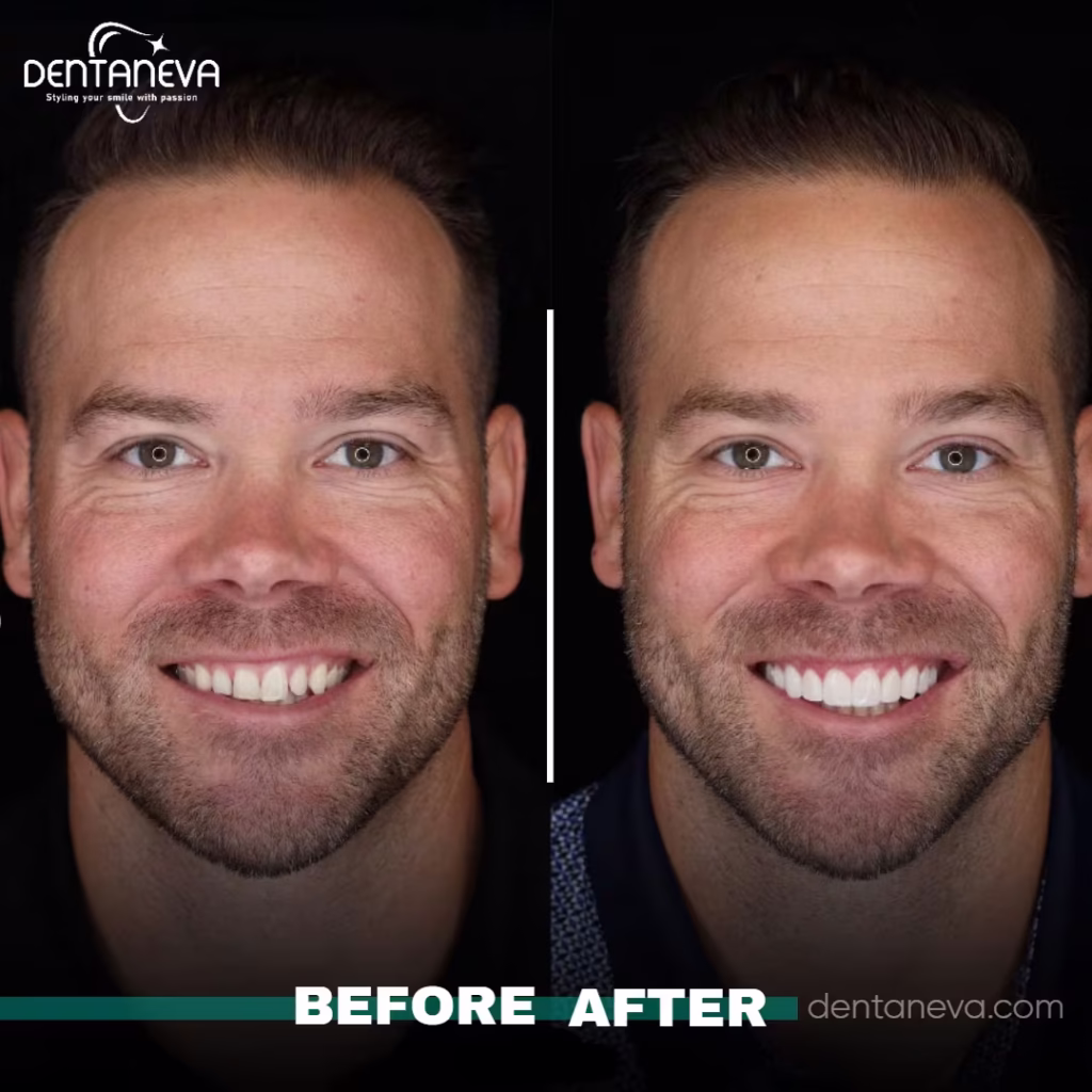 Dental Implants UK Cost: 2025 Prices and Affordable Alternative Abroad 2 how much dental implants cost before after