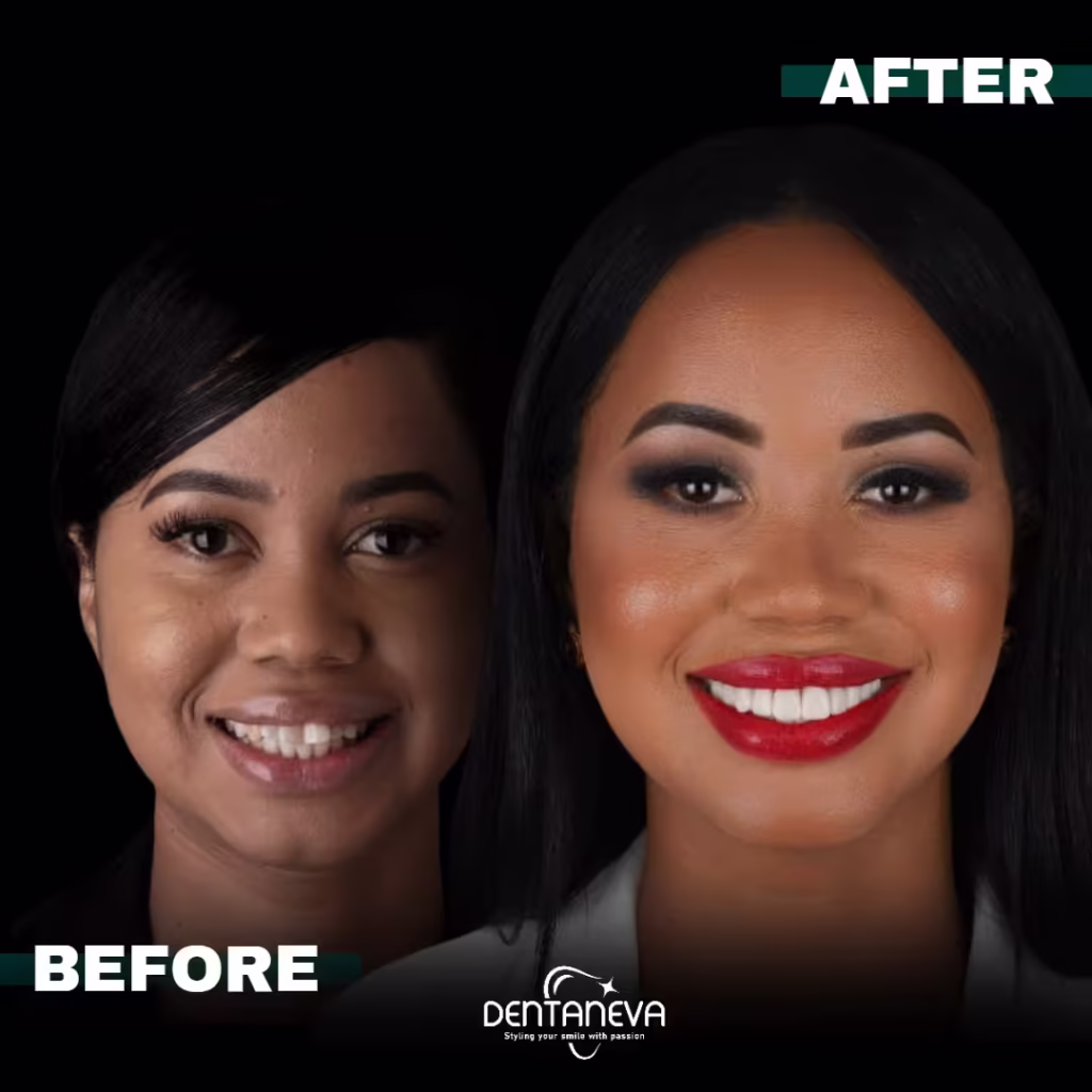 Top 5 Facts About the Real Cost of Dental Implants UK – Save Big Without Sacrificing Quality 2 all on 4 dental implants cost After Before