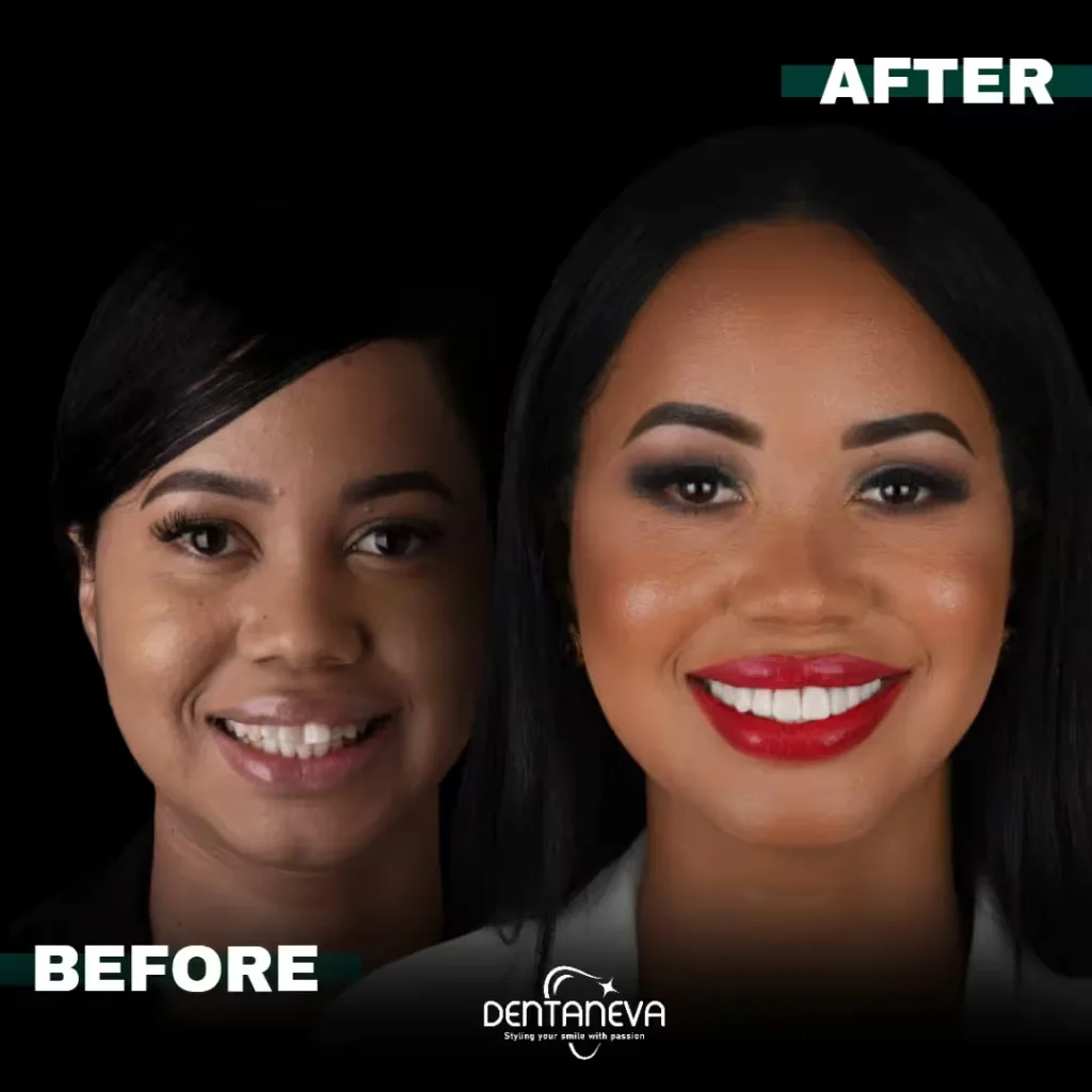 Top 5 Facts About the Real Cost of Dental Implants UK – Save Big Without Sacrificing Quality 2 all on 4 dental implants cost After Before