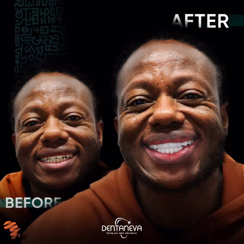 Affordable All on 4 Dental Implants Cost: Everything You Need to Know for a Beautiful Smile in 2025 2 all on 4 dental implants cost Before After