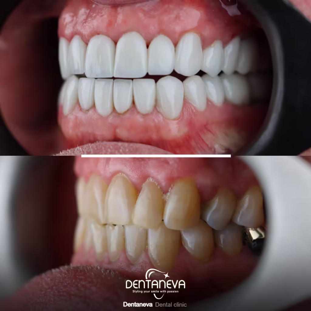 All on Four Dental Implants Cost: A Clear and Honest Breakdown 3 how much is a full set of dental implants uk After and Before