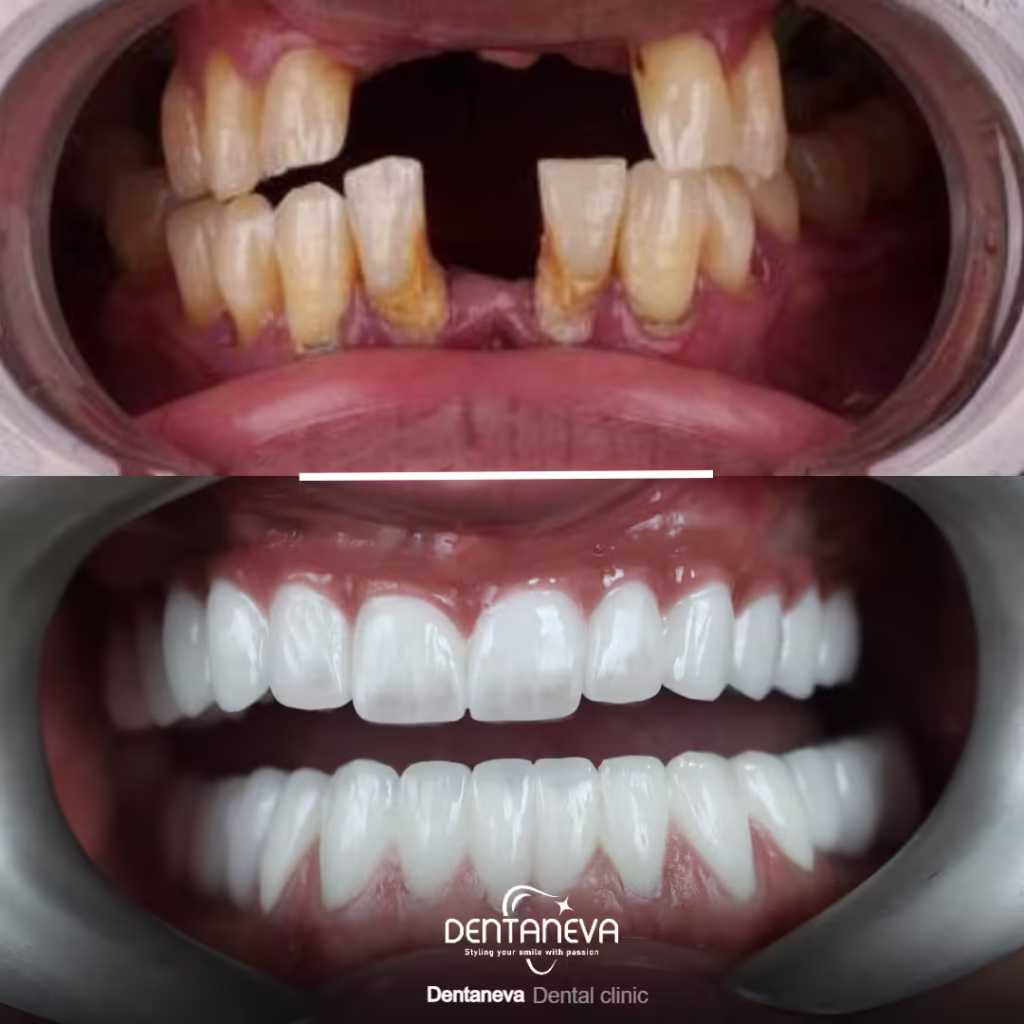 Top 5 Things to Know About Full Arch Dental Implants Before You Decide 3 screwless dental implants Before After