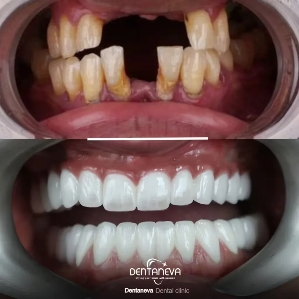 Top 5 Facts About the Real Cost of Dental Implants UK – Save Big Without Sacrificing Quality 3 screwless dental implants Before After