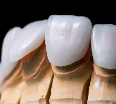 Dental Veneers Dental Veneers