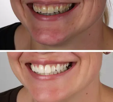Jaw-surgery Jaw surgery